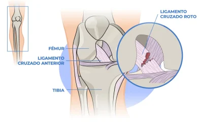 Como se producen las lesiones de rodilla