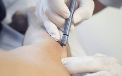 Micro electrolisis percutánea