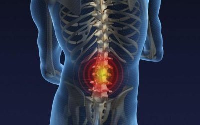 Terapia para la columna con hernia